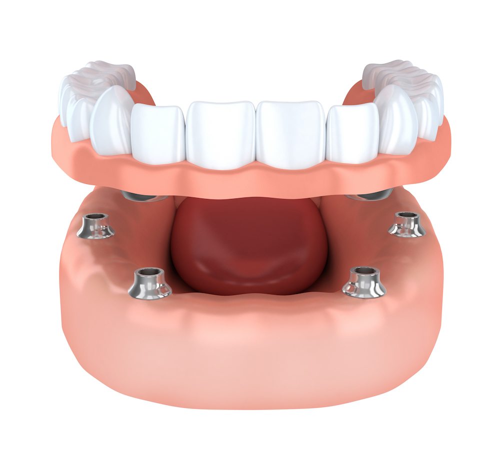 Photo of Service Snap On Dentures