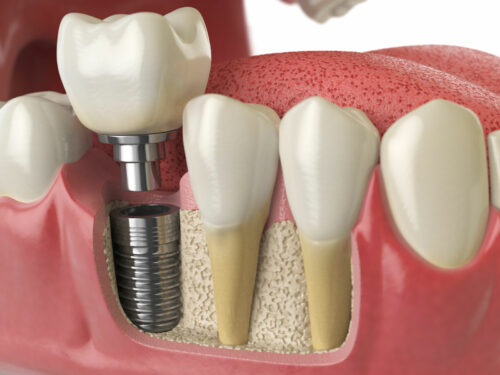 Photo of Dental Implants