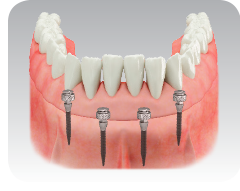 Photo of Mini Dental Implants