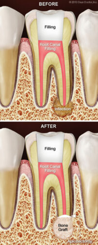 Photo of Before and After Root Canal