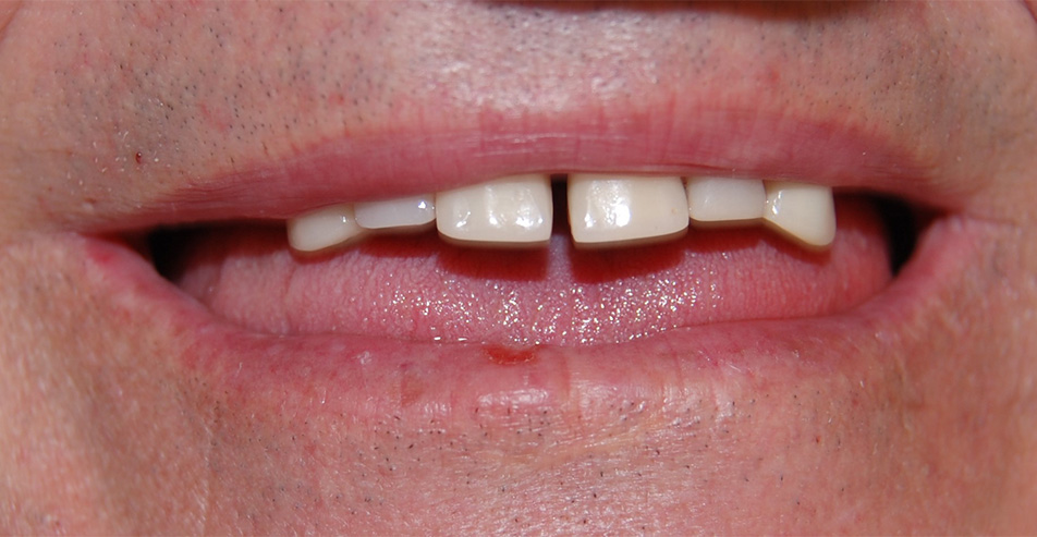 Photo of Snap On Denture Before and After 1