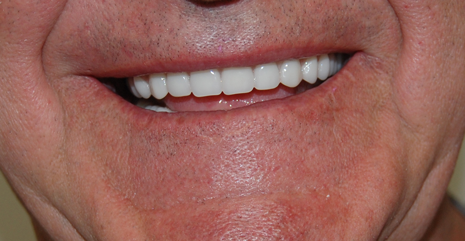 Photo of Snap On Denture Before and After 2